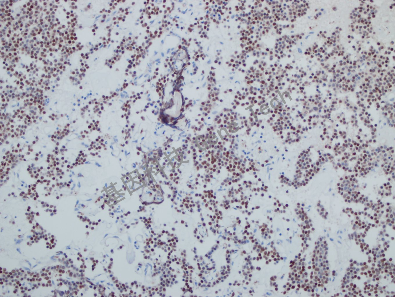 SF-1 垂体腺瘤-6_副本.jpg