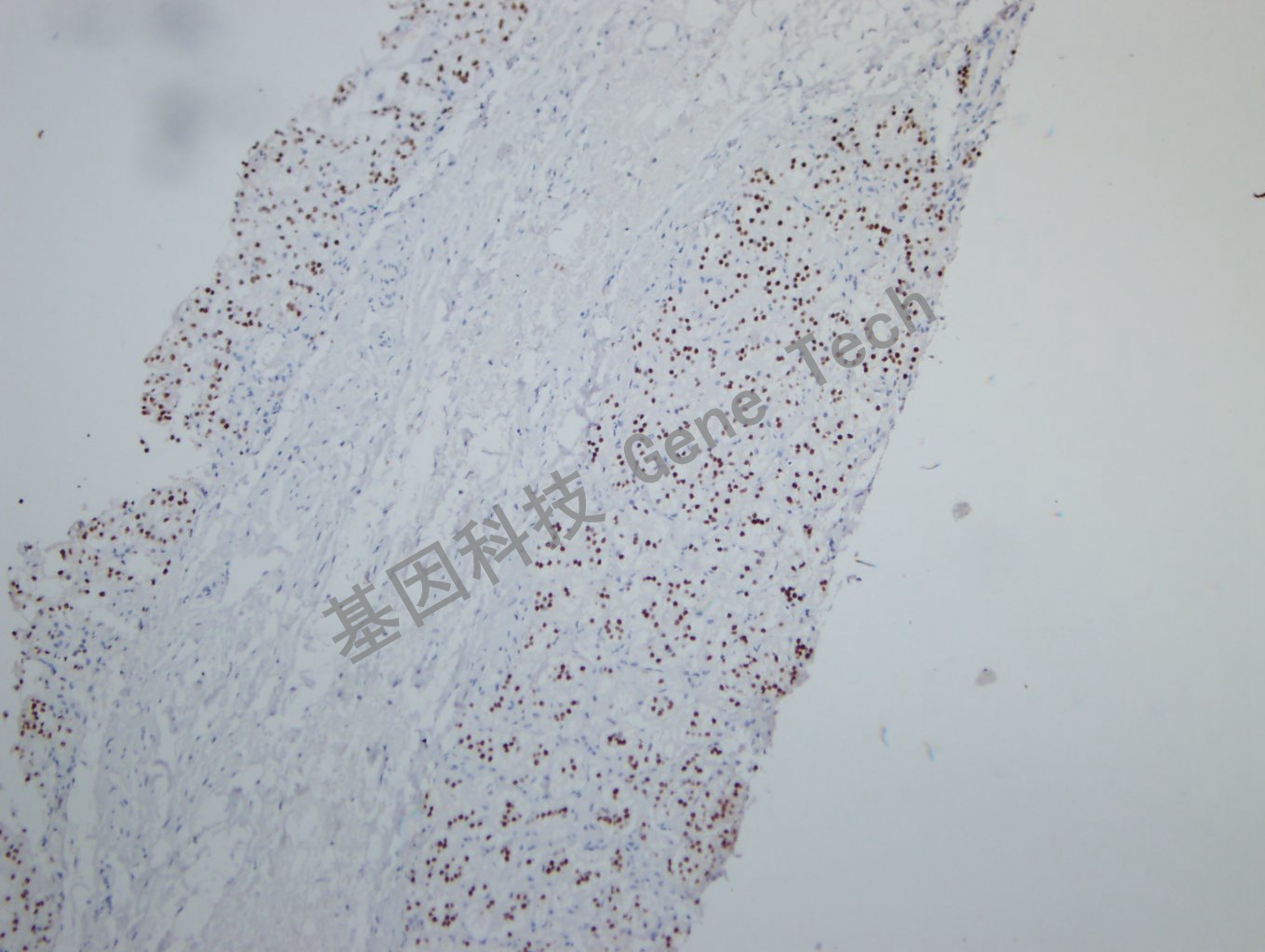 SF-1 肾上腺皮质癌-1_副本.jpg