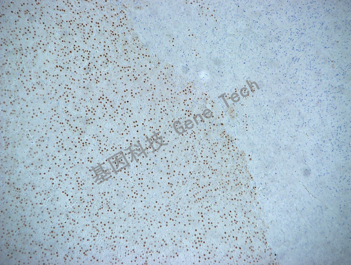 SF-1 肾上腺嗜铬细胞瘤10X_副本.jpg