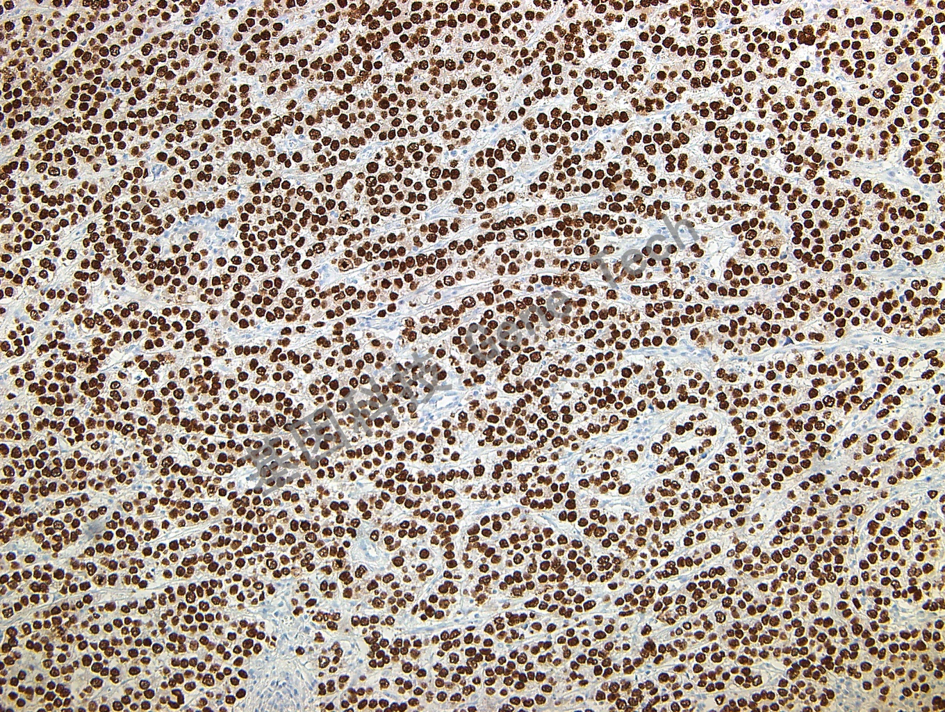 1681799236171305.jpg SALL4 GT2190 精原细胞瘤 10X_副本.jpg