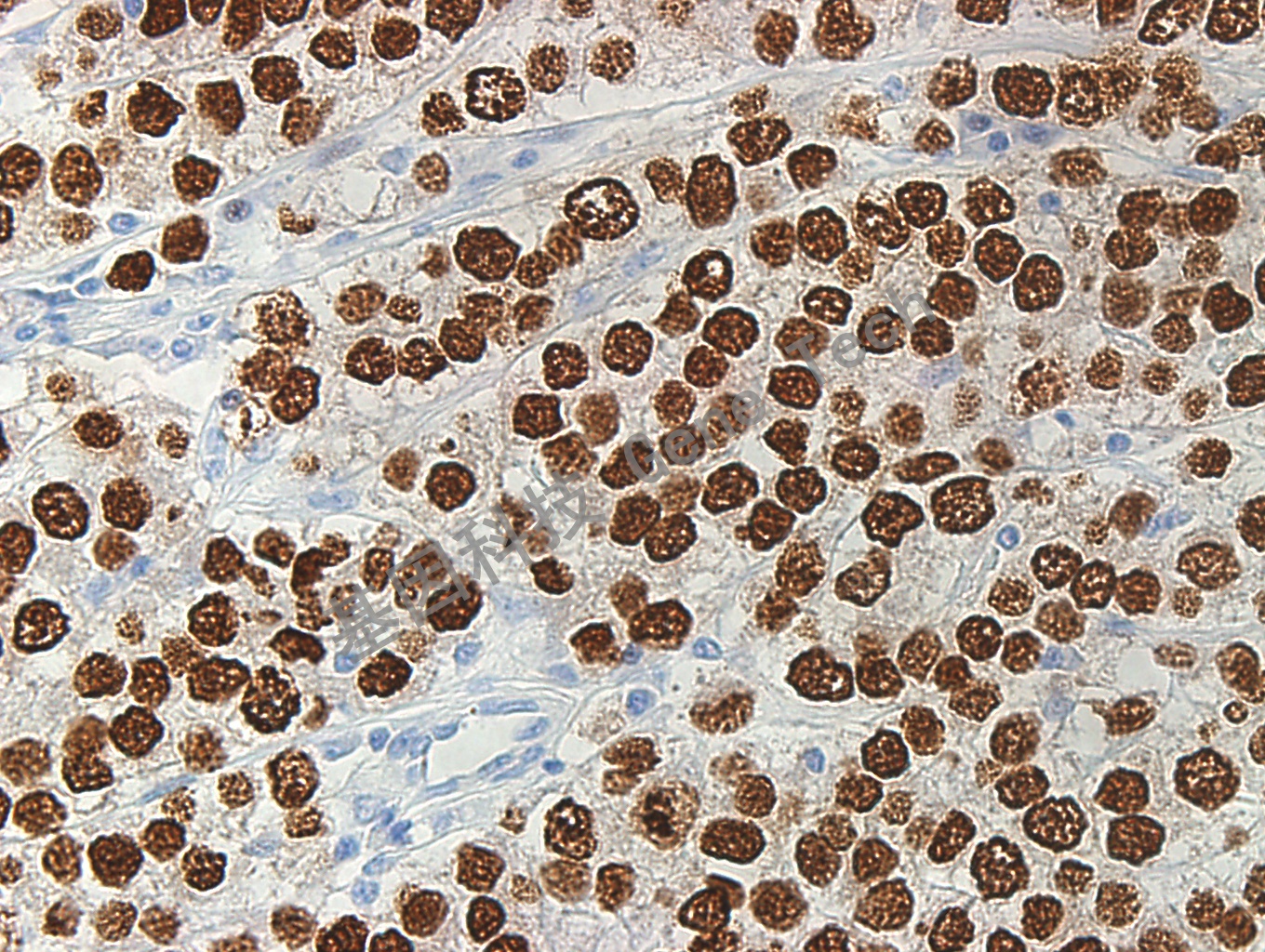 1681799241863196.jpg SALL4 GT2190 精原细胞瘤 40X_副本.jpg