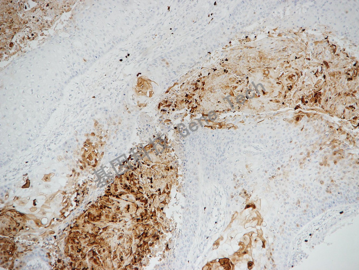 S100p GT2286-食道癌_副本.jpg