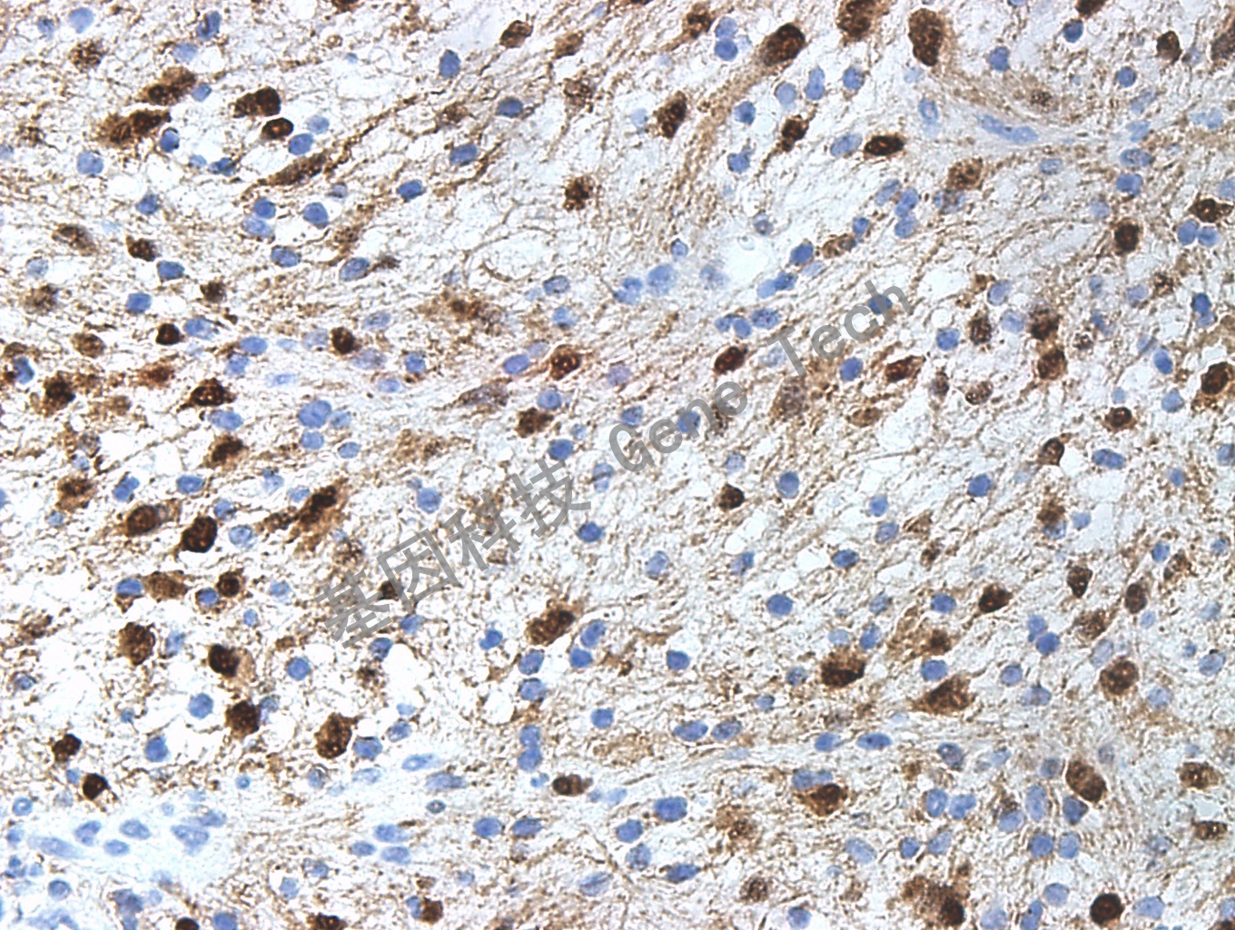 S100 GZ0311 神经鞘瘤 40X_副本.jpg