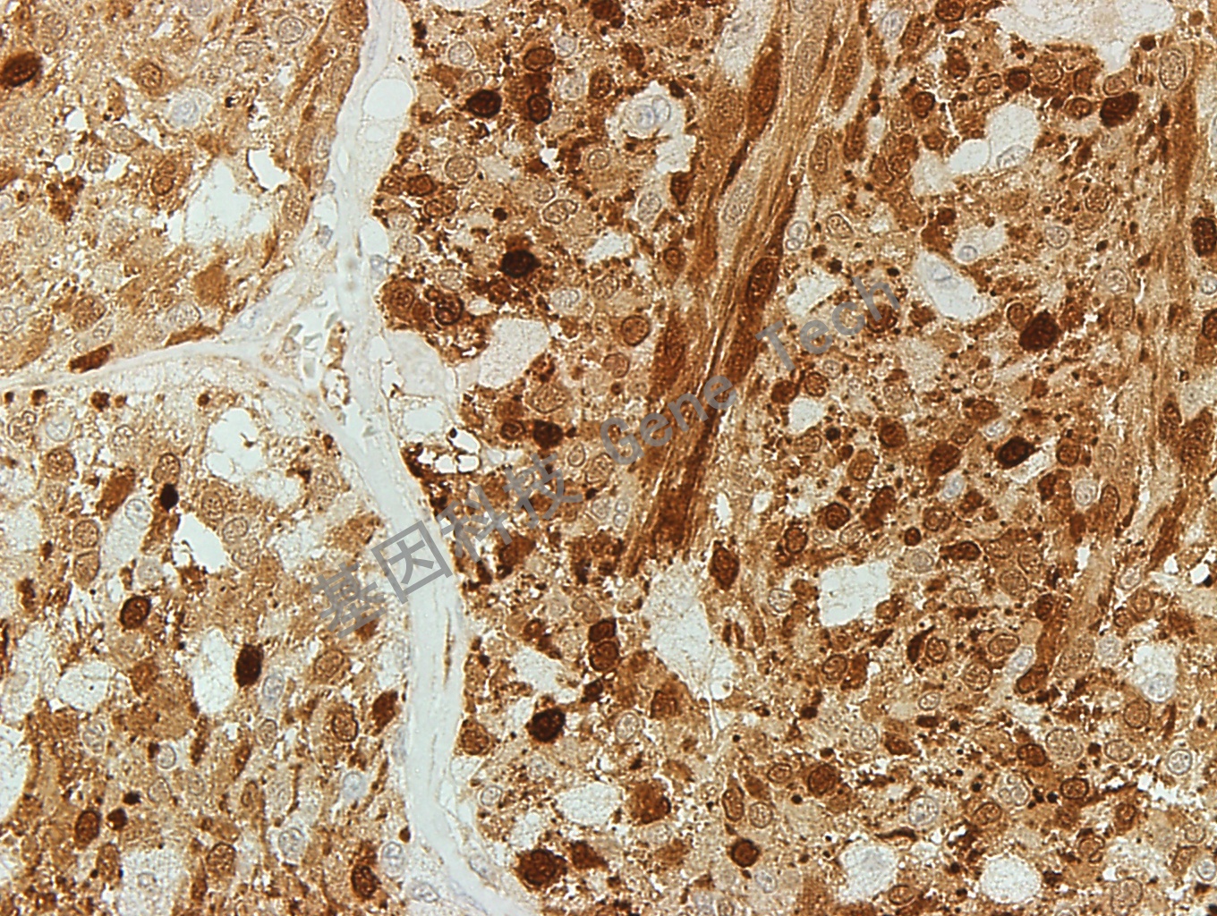 S100-4(Malignant melanoma)-400_副本.jpg