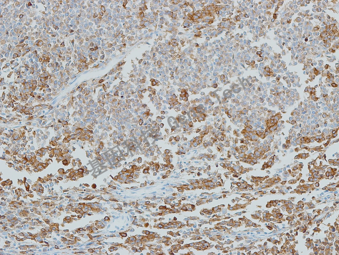 20190508-8 Melanoma S4 黑素瘤-2_副本.jpg