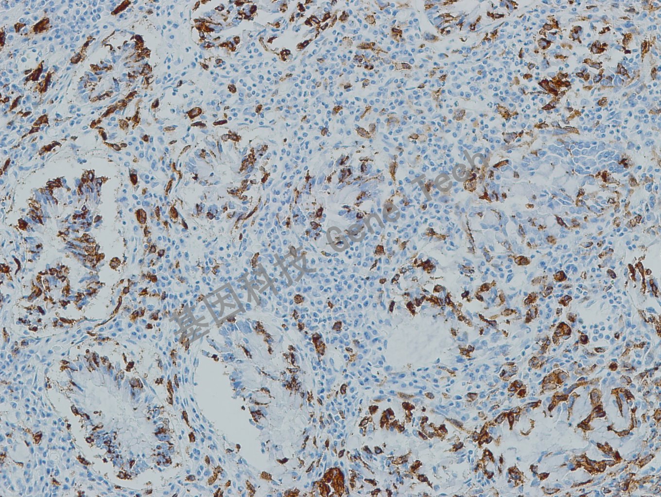 20190508-8 Melanoma S4 黑素瘤-3_副本.jpg