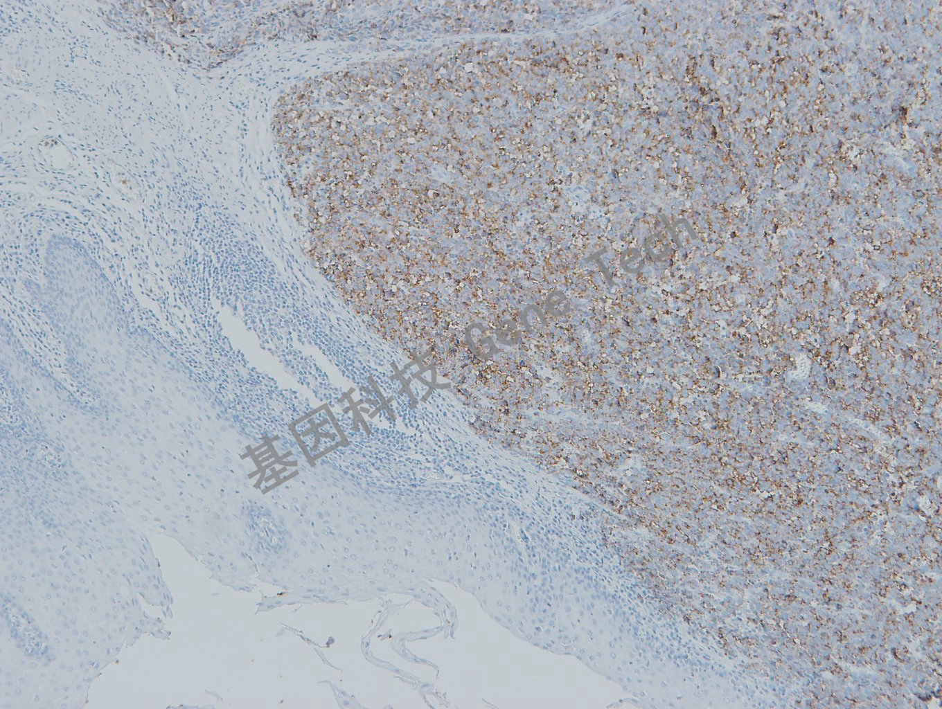 20190508-9 Melanoma S5 黑素瘤-1_副本.jpg