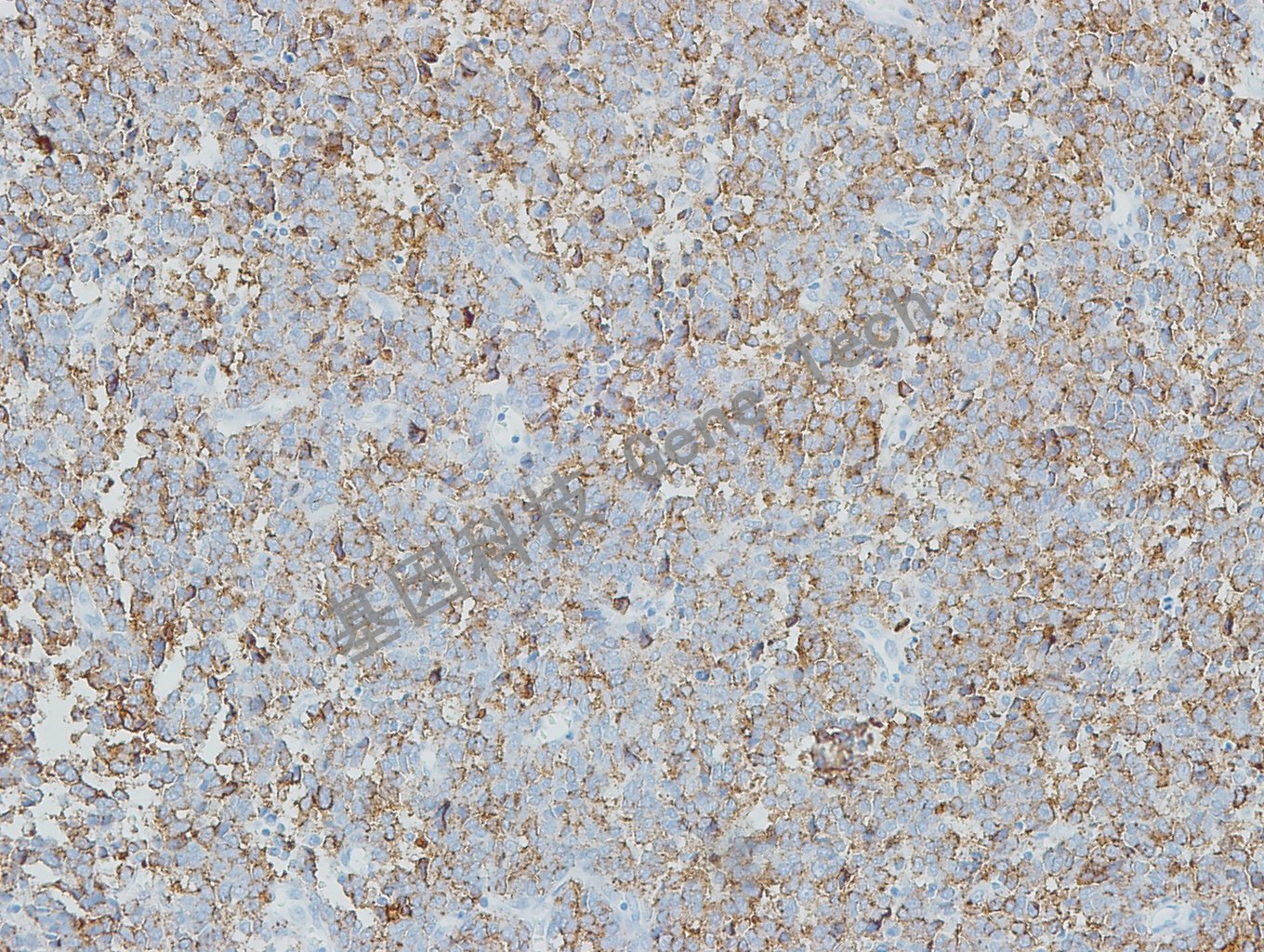 20190508-9 Melanoma S5 黑素瘤-2_副本.jpg