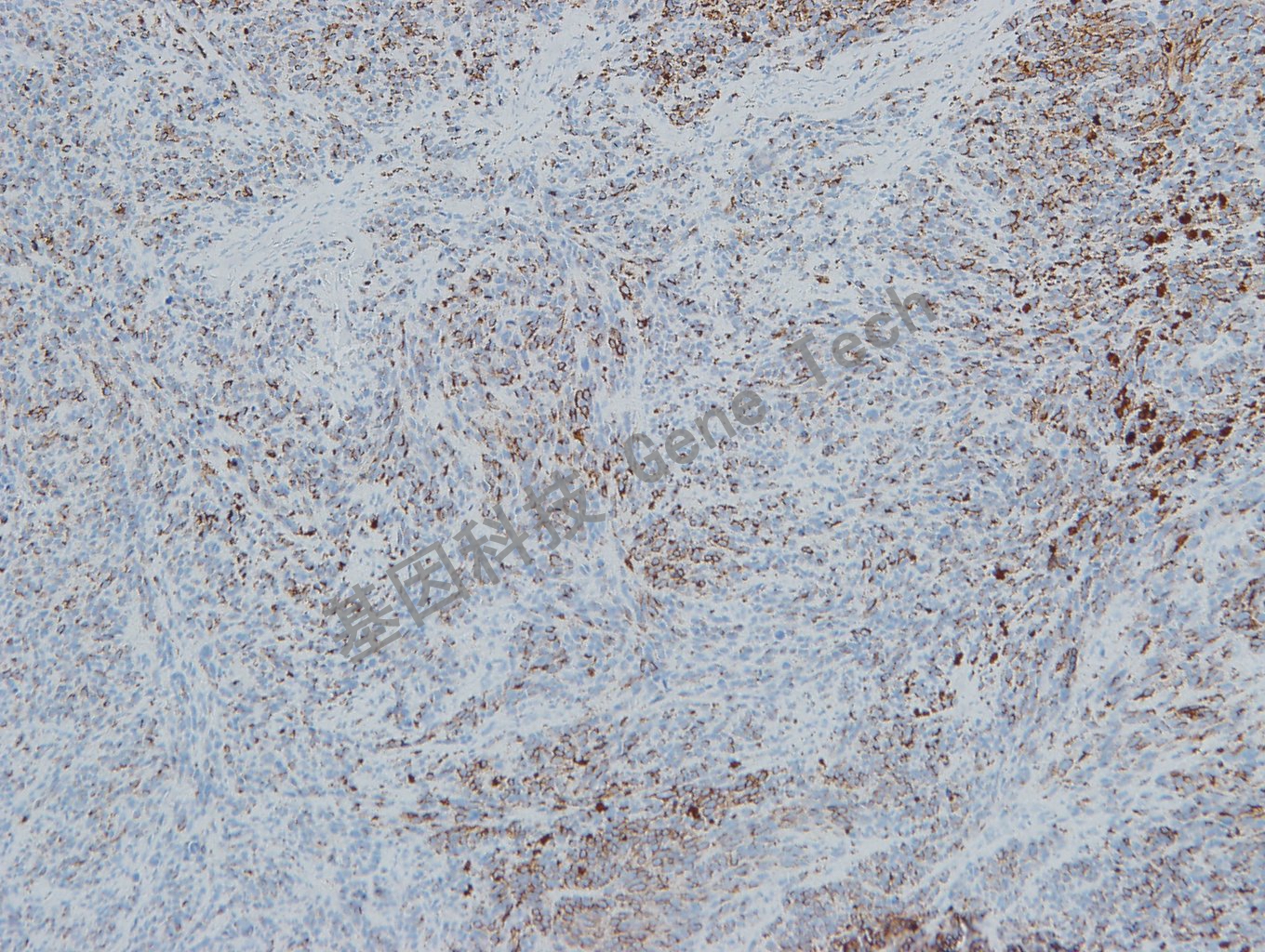 20190508-10 Melanoma S6 黑素瘤-1_副本.jpg