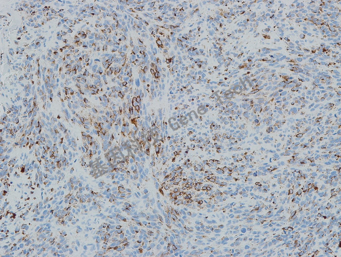 20190508-10 Melanoma S6 黑素瘤-2_副本.jpg