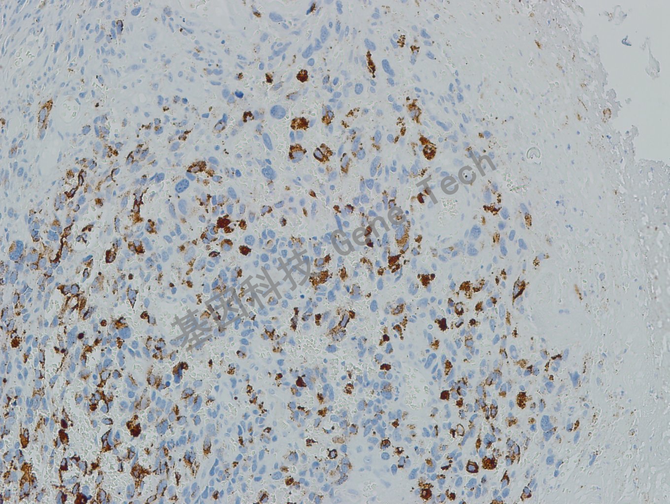 20190508-10 Melanoma S6 黑素瘤-3_副本.jpg