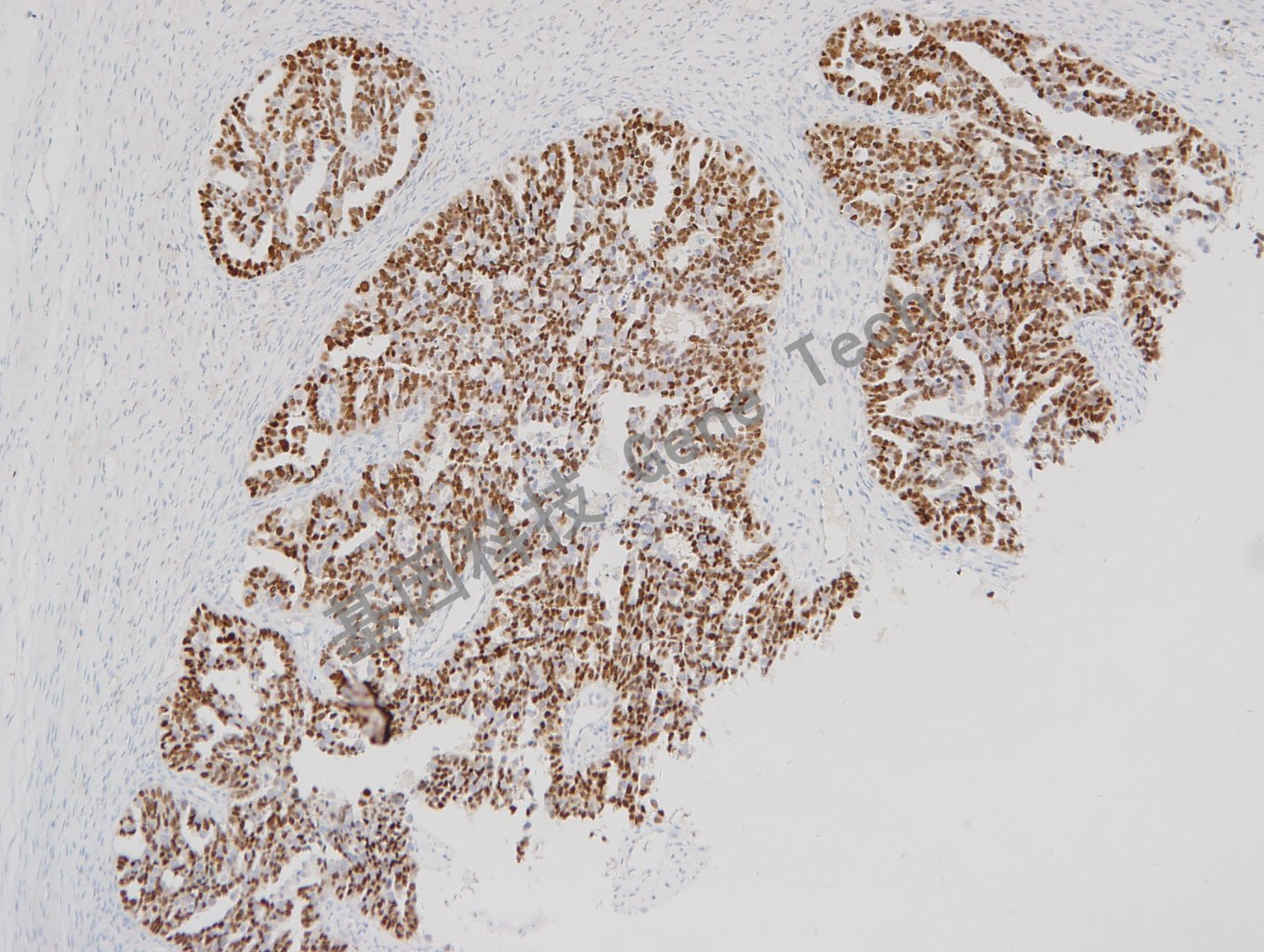 1682665728260118.jpg 20171219-15 卵巢癌_副本.jpg