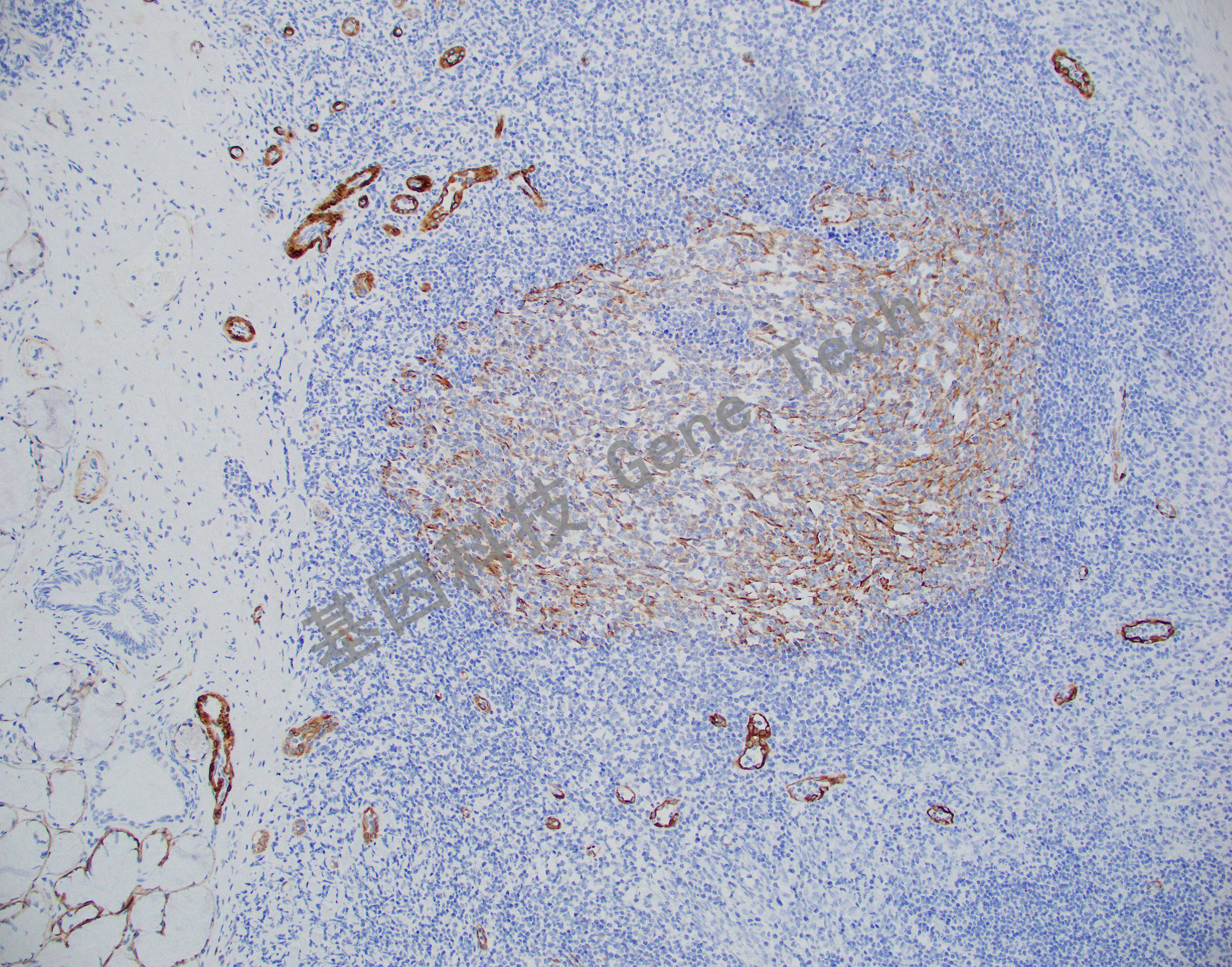 用 smooth muscle myosin(gm3558)染色,细胞浆阳性,dab显色