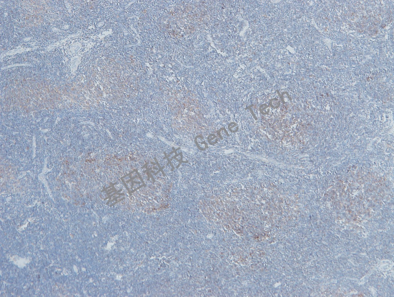 20190506-9 GCET2 U34 滤泡淋巴瘤-1_副本.jpg