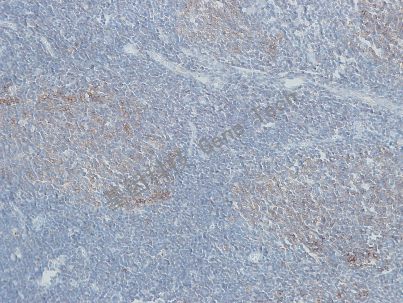 20190506-9 GCET2 U34 滤泡淋巴瘤-2_副本.jpg