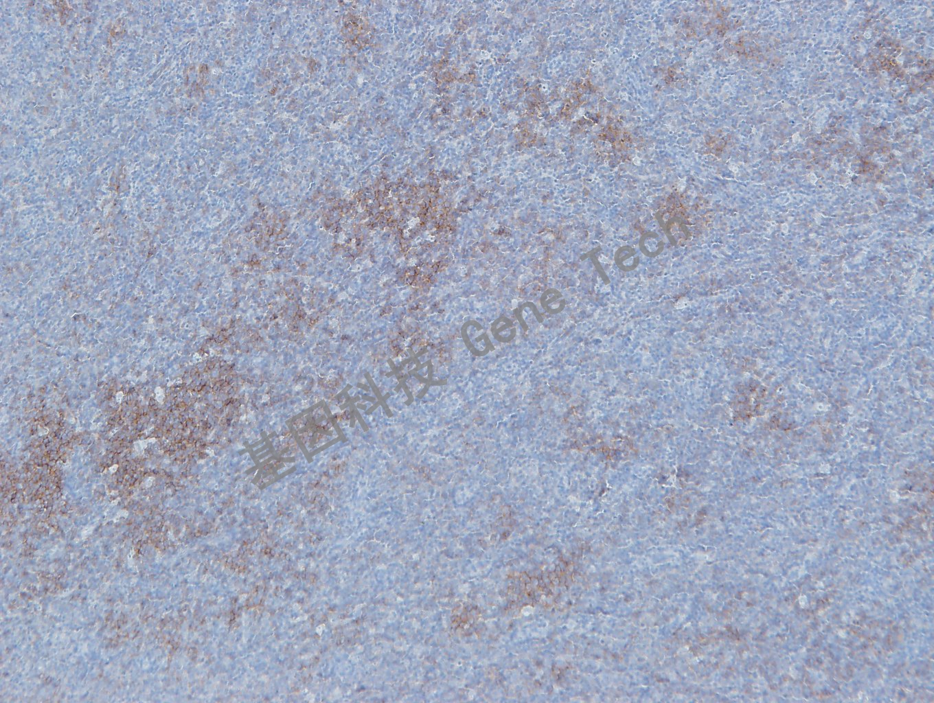 20190506-10 GCET2 U41 滤泡淋巴瘤-1_副本.jpg