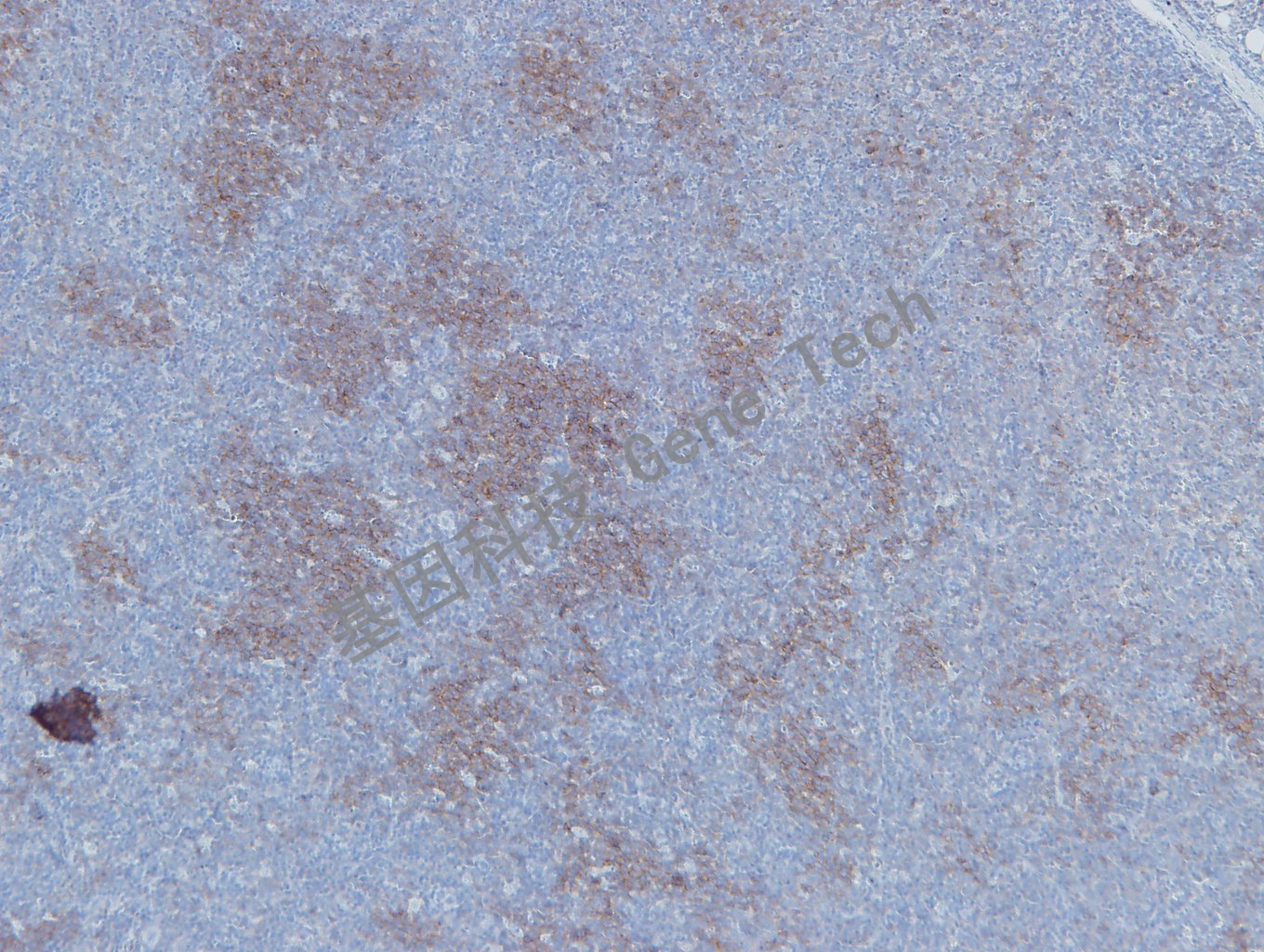 20190506-10 GCET2 U41 滤泡淋巴瘤-2_副本.jpg