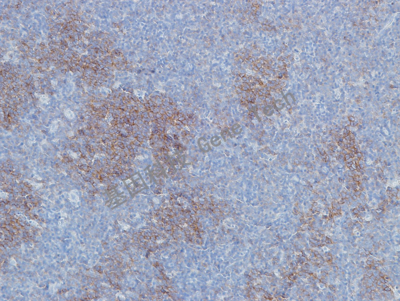 20190506-10 GCET2 U41 滤泡淋巴瘤-3_副本.jpg