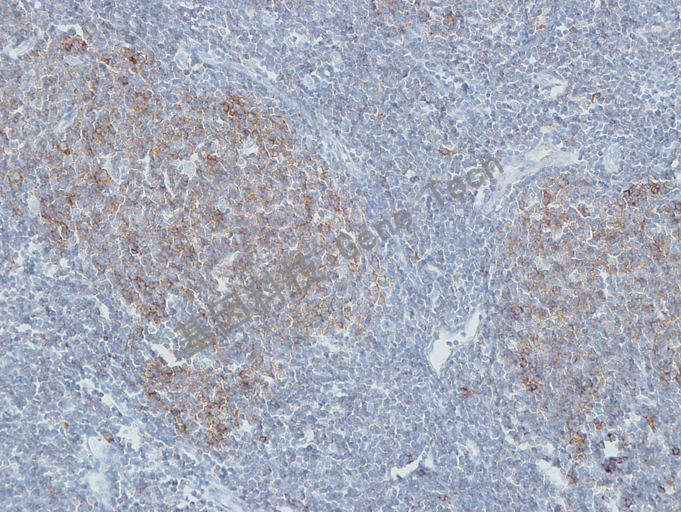 20190506-11 GCET2 U45 滤泡淋巴瘤-2_副本.jpg