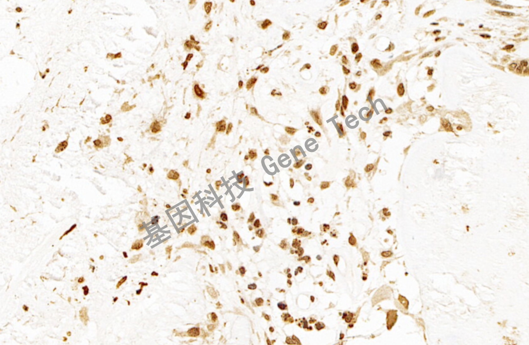 H3K36M 软骨肉瘤 20倍 细胞核_副本.jpg