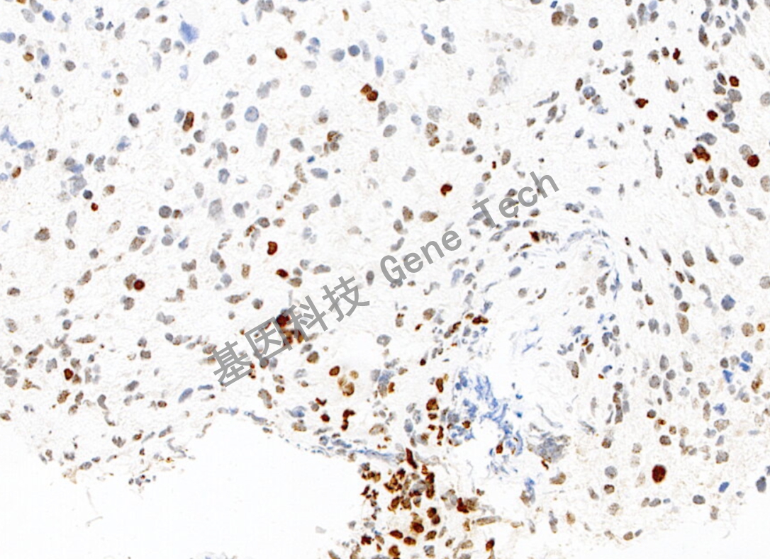 H3K27Me3 20倍 细胞核 胶质瘤_副本.jpg