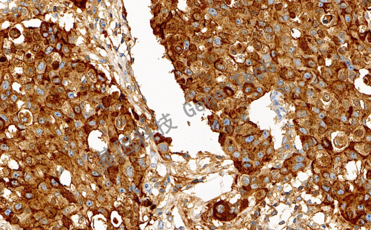 1684375605226146.jpg GCDFP-15 20倍 细胞浆 乳腺癌_副本.jpg