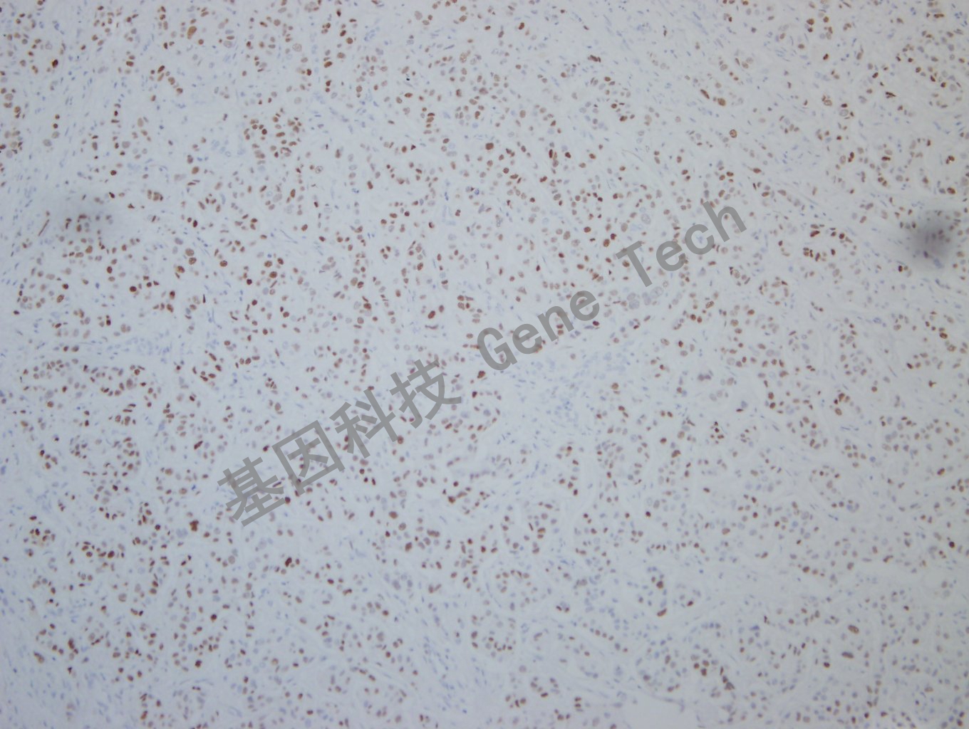 20190925G-9 nordiqc ER -3Breast carcinoma -2_副本.jpg