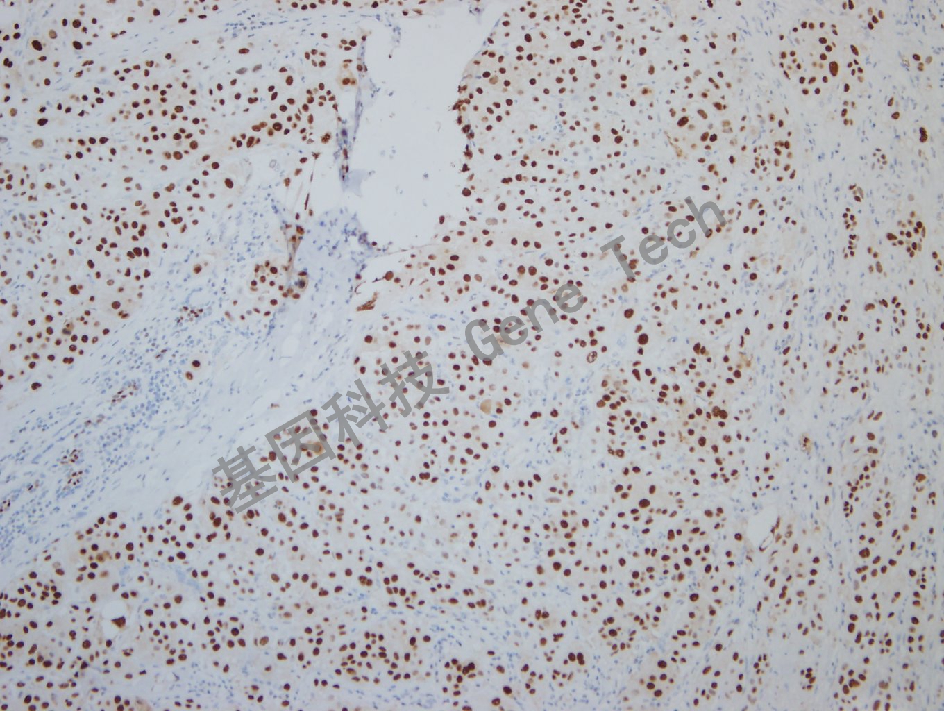 20190925G-9 nordiqc ER -4Breast carcinoma -1_副本.jpg