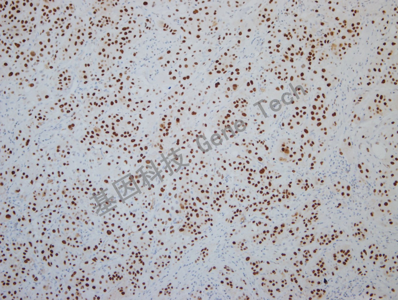 20190925G-9 nordiqc ER -4Breast carcinoma -3_副本.jpg