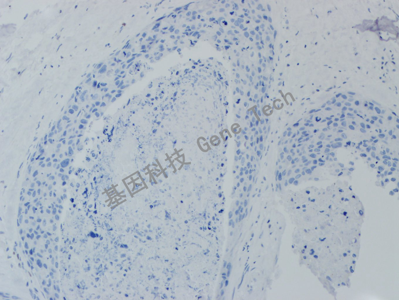 ER GT2056 乳腺癌 阴性 20X   20191023-4_副本.jpg