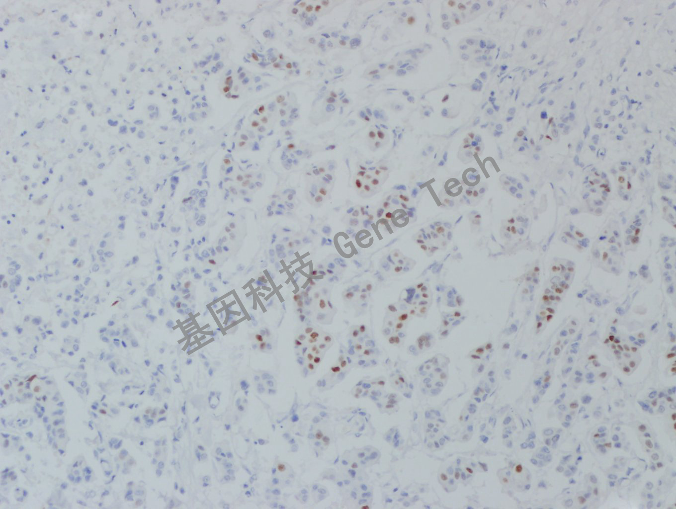 ER GT2056 乳腺癌弱阳 20X  20190426-4_副本.jpg