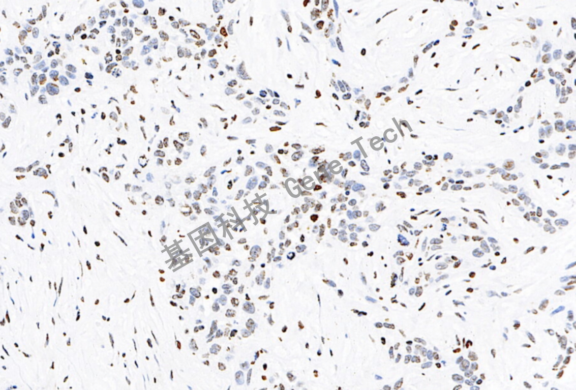 ERCC1 20倍细胞核 前列腺癌_副本.jpg