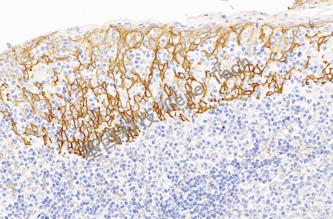 EGFR p40 20倍 细胞膜+细胞浆 扁桃体_副本.jpg