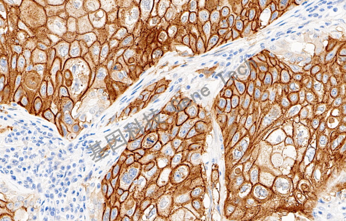 EGFR B71 20倍 细胞膜+细胞浆 肺鳞癌_副本.jpg