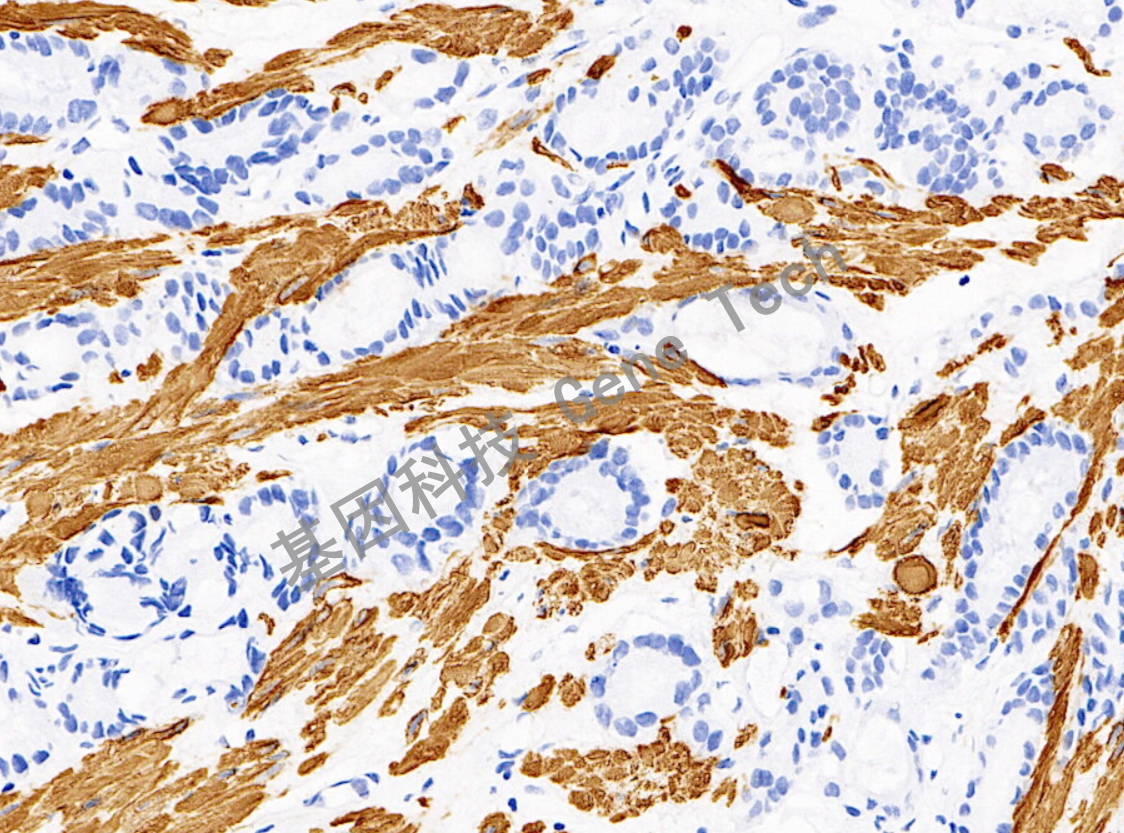 Desmin 20倍 细胞浆 平滑肌_副本.jpg