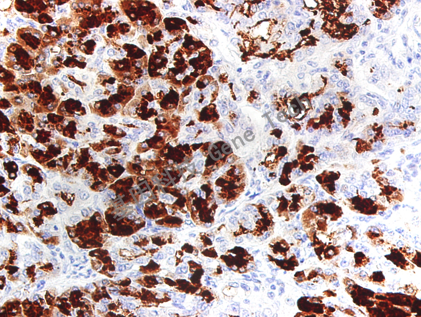 1691140505883472.jpg trypsin 40X 胰腺癌_副本.jpg