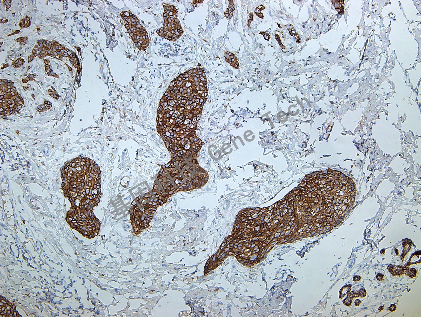 E-Cadherin GT2107 乳腺癌_副本.jpg